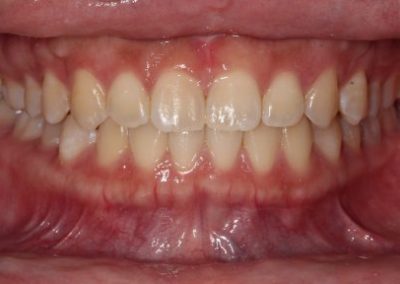 Midline Diastemer - After
